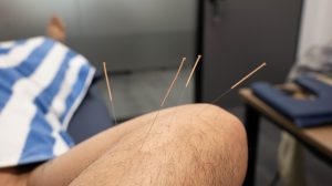 dry needling on leg